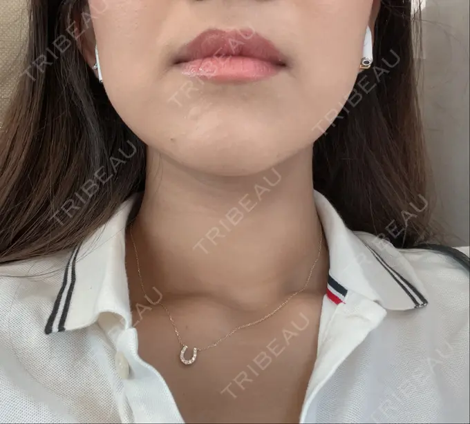 脂肪溶解注射（顔） ルラ美容クリニック 神戸院 AFTER メイン用