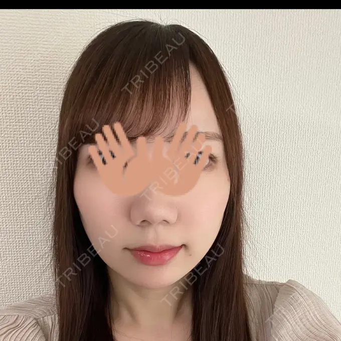 あごプロテーゼ WOM CLINIC GINZA （ワム クリニック ギンザ） AFTER メイン用