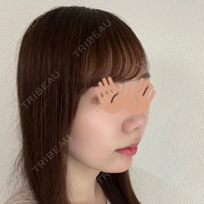 あごプロテーゼ WOM CLINIC GINZA （ワム クリニック ギンザ） DAY 77 メイン用