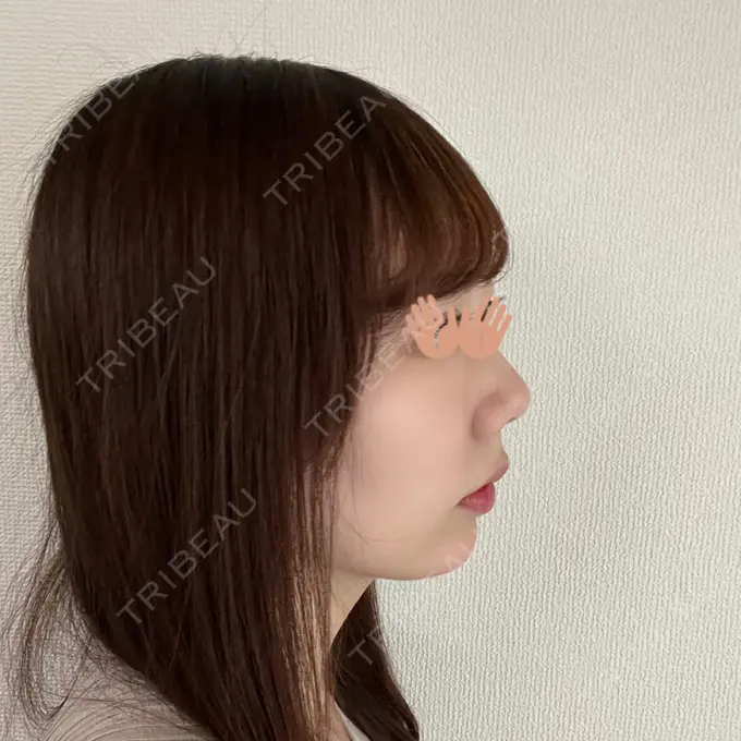 あごプロテーゼ WOM CLINIC GINZA （ワム クリニック ギンザ） DAY 77 メイン用