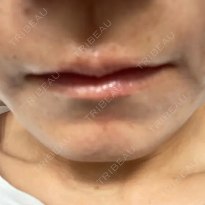 ヒアルロン酸注入（唇） / ボトックス（口角） フィラークリニック 名古屋栄院 AFTER メイン用