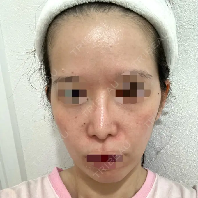 その他（肌） / イオン導入 / ルメッカ ルラ美容クリニック 横浜院 DAY 1 メイン用