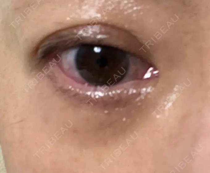 下まぶたの脂肪取り 東京イセアクリニック DAY 18 メイン用