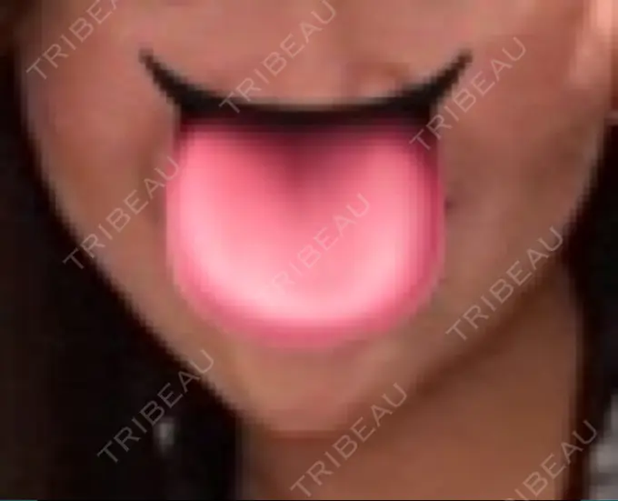 ハイフ（顔） HAAB BEAUTY CLINIC 横浜院 DAY 24 メイン用