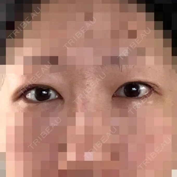 目尻切開 / タレ目形成・グラマラスライン（埋没） LOUIS CLINIC 二子玉川院【ルイクリニック】 DAY 8 メイン用