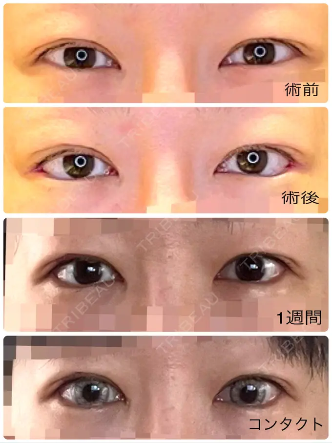 目尻切開 / タレ目形成・グラマラスライン（埋没） LOUIS CLINIC 二子玉川院【ルイクリニック】 DAY 8 メイン用