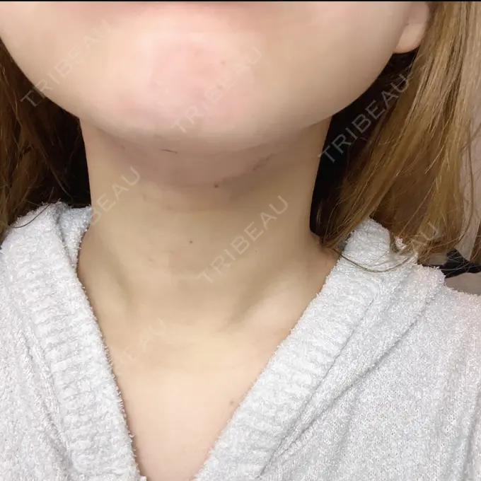 脂肪吸引（顔） / ボトックス（エラ・小顔） ルラ美容クリニック 大阪本院 DAY 2 メイン用