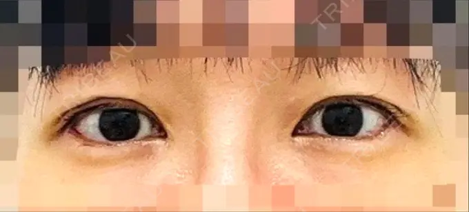 目尻切開 / タレ目形成・グラマラスライン（埋没） LOUIS CLINIC 二子玉川院【ルイクリニック】 DAY 10 メイン用