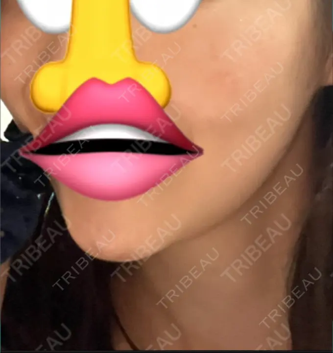 ハイフ（顔） HAAB BEAUTY CLINIC 横浜院 DAY 34 メイン用