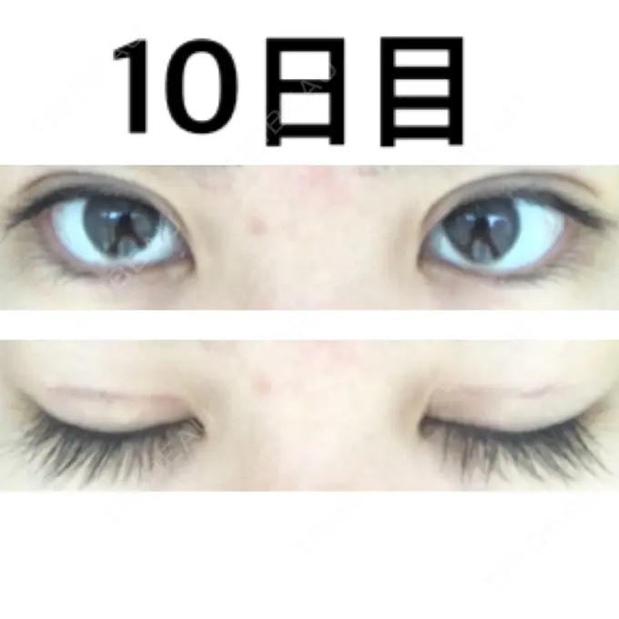 二重切開 みずほクリニック DAY 10 メイン用