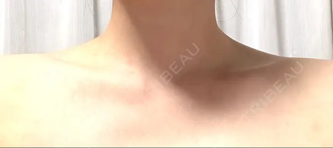 ボトックス（肩） 湘南美容クリニック 静岡院 AFTER メイン用