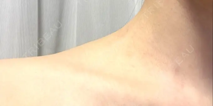 ボトックス（肩） 湘南美容クリニック 静岡院 DAY 3 メイン用