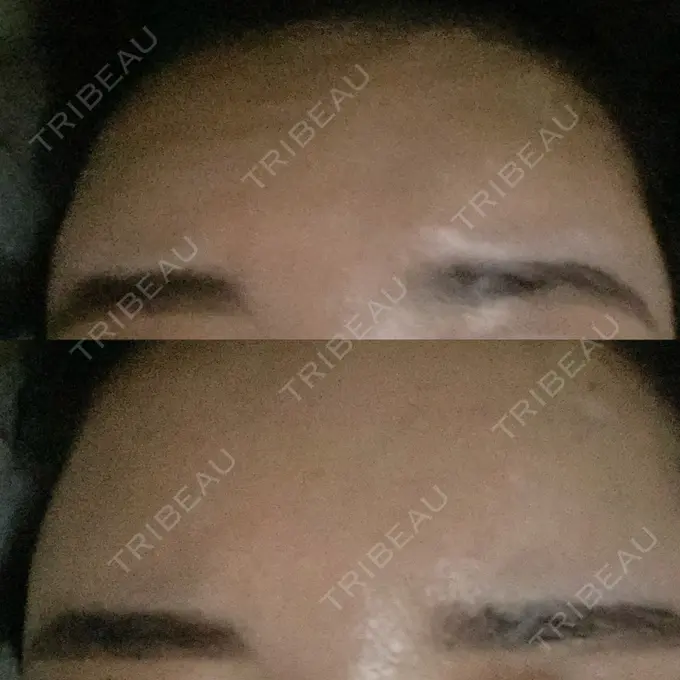 ボトックス（額） 東京美容医療クリニック 池袋院 DAY 2 メイン用