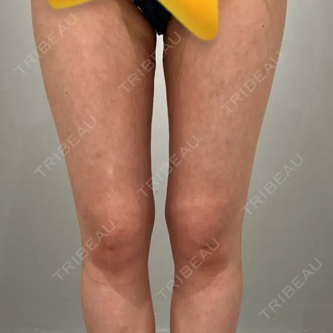 脂肪吸引（脚） Mods Clinic（モッズクリニック） 名古屋院 AFTER メイン用