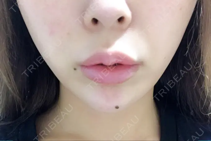 ボトックス（あご） / ヒアルロン酸注入（あご） / ボトックス（エラ・小顔） / ヒアルロン酸注入（唇） 川越TAクリニックアソシエ DAY 3 メイン用