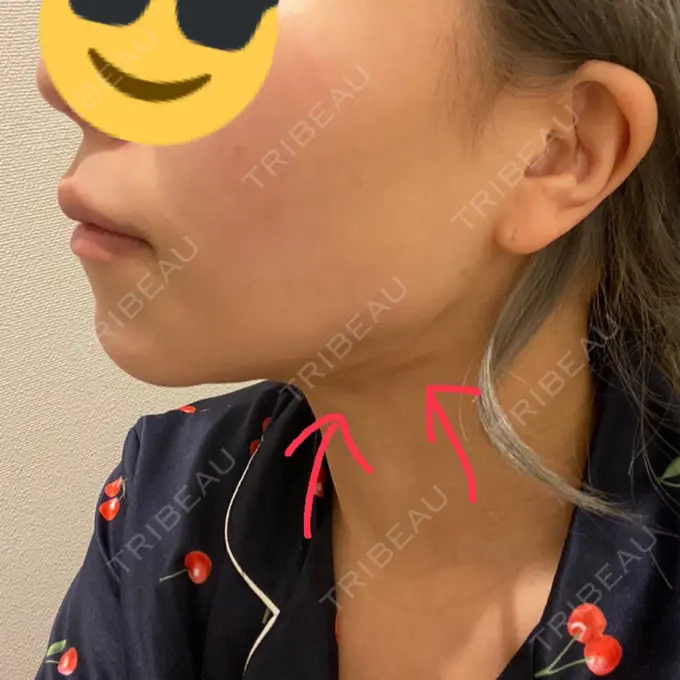 脂肪吸引（顔） Casa de GRACIA GINZA 【カーサデグラシアギンザ】 DAY 46 メイン用