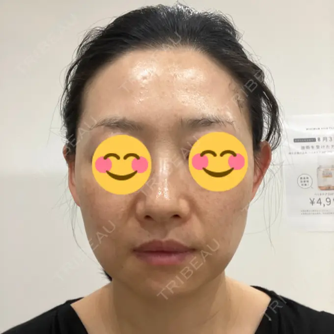 エレクトロポレーション / 毛穴洗浄（ハイドラフェイシャルなど） ミニマムスキンクリニック池袋 AFTER メイン用