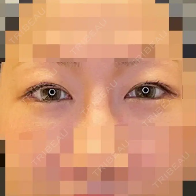 目尻切開 / タレ目形成・グラマラスライン（埋没） LOUIS CLINIC 二子玉川院【ルイクリニック】 DAY 14 メイン用