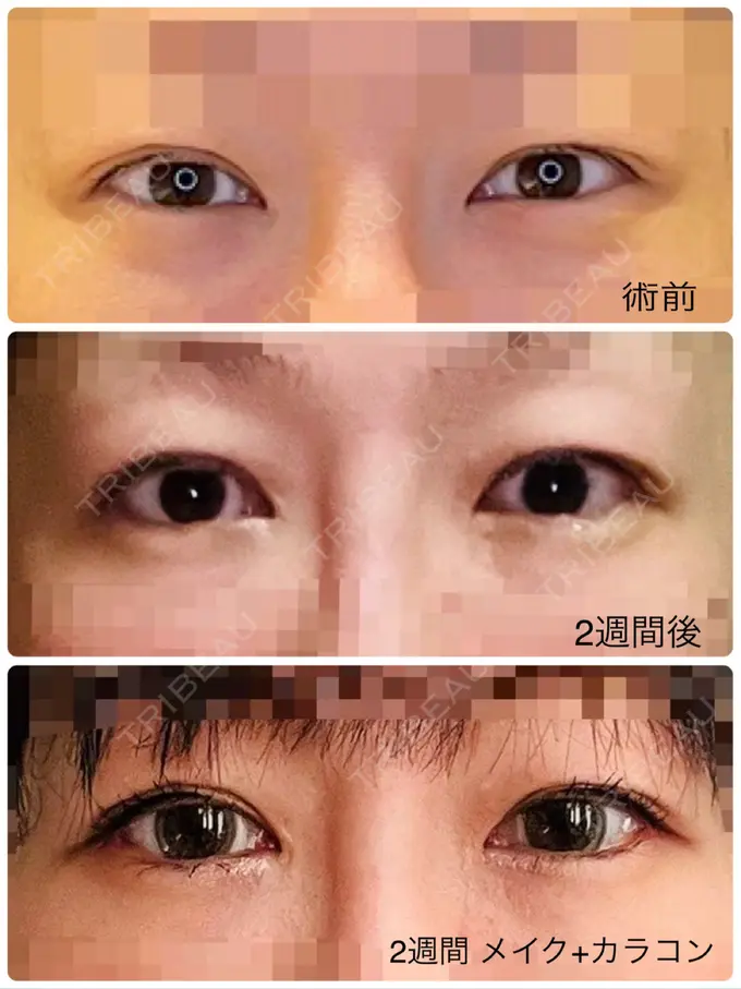 目尻切開 / タレ目形成・グラマラスライン（埋没） LOUIS CLINIC 二子玉川院【ルイクリニック】 DAY 14 メイン用