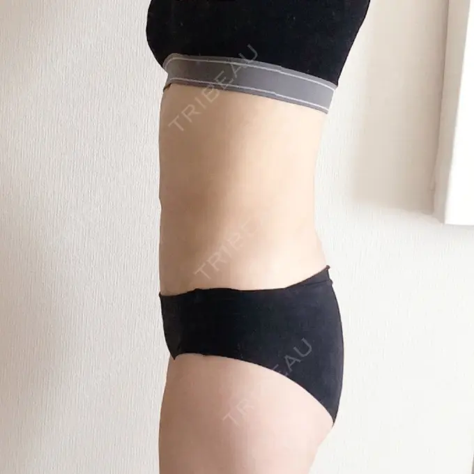 脂肪吸引（お腹） / 脂肪吸引（腰） GAYA body design clinic DAY 95 メイン用