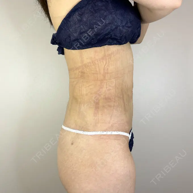 脂肪吸引（お腹） / 脂肪吸引（腰） GAYA body design clinic DAY 32 メイン用