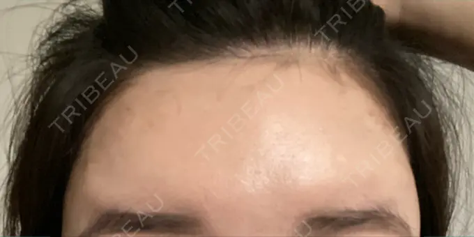 ボトックス（額） 東京美容医療クリニック 池袋院 DAY 4 メイン用