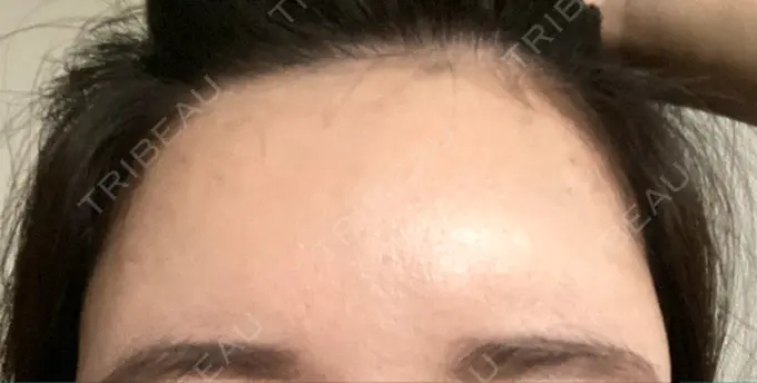 ボトックス（額） 東京美容医療クリニック 池袋院 DAY 4 メイン用