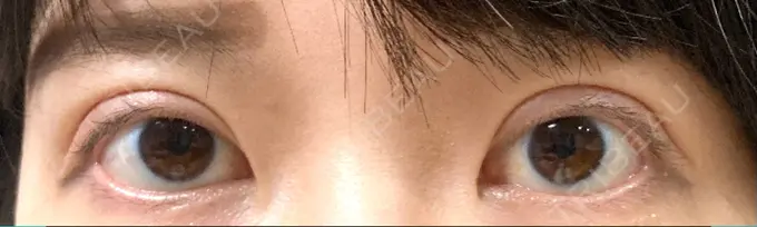 二重切開 / 目元修正 心斎橋コムロ美容外科クリニック DAY 273 メイン用