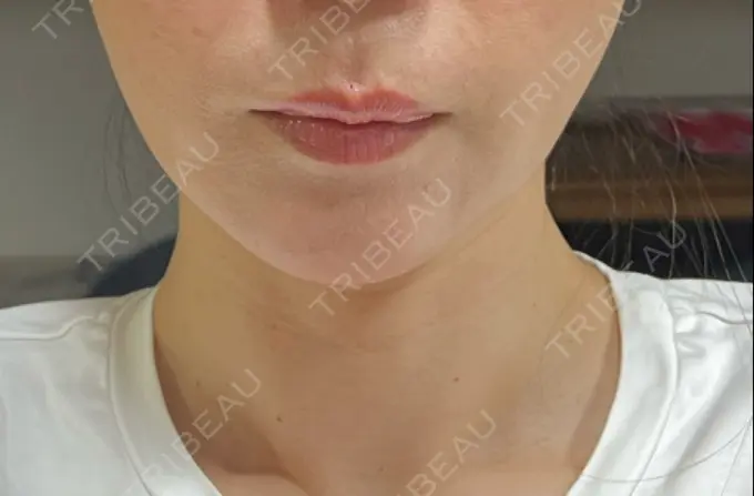 ヒアルロン酸注入（唇） ロレシー美容クリニック 心斎橋駅前院 DAY 1 メイン用