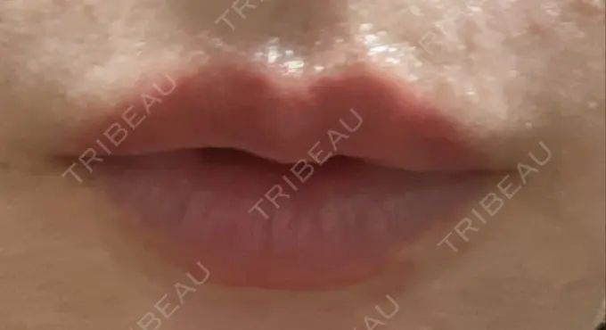 ヒアルロン酸注入（唇） ロレシー美容クリニック 心斎橋駅前院 DAY 1 メイン用