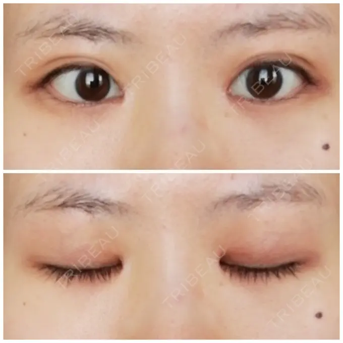 目頭切開 / 目尻切開 / 水光注射（ハリ・美肌） エートップ美容整形外科 AFTER メイン用