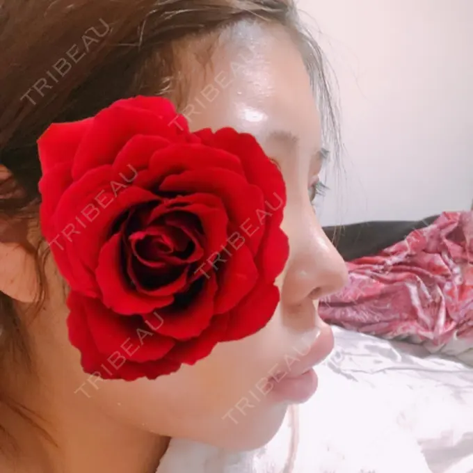 二重切開 / クマ治療 / 骨切り（あご） / 骨削り（エラ） / 骨削り（頬） / 脂肪吸引（顔） / 脂肪吸引（二の腕） / 下まぶたの脂肪取り / タレ目形成・グラマラスライン（切開） / 軟骨移植 / 骨切幅寄せ / ヒアルロン酸注入（涙袋） / その他（鼻） / その他（胸） ジュエリー美容外科 DAY 10 メイン用