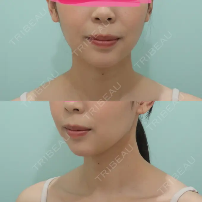 あごプロテーゼ WOM CLINIC GINZA （ワム クリニック ギンザ） AFTER メイン用