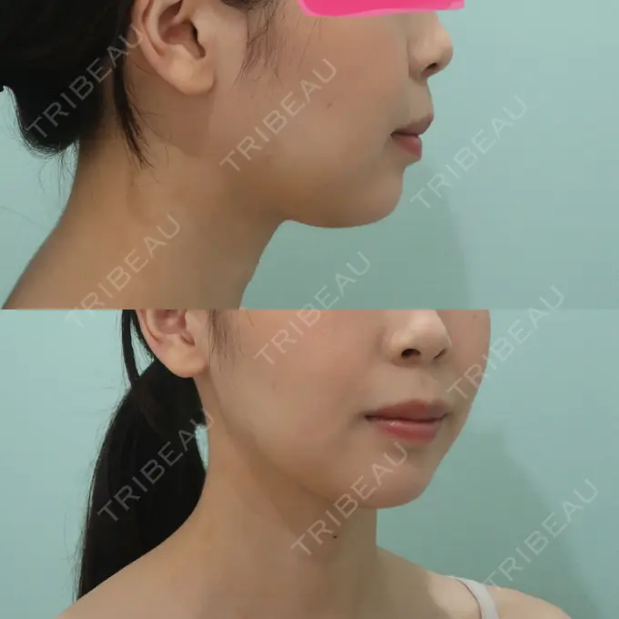 あごプロテーゼ WOM CLINIC GINZA （ワム クリニック ギンザ） DAY 8 メイン用