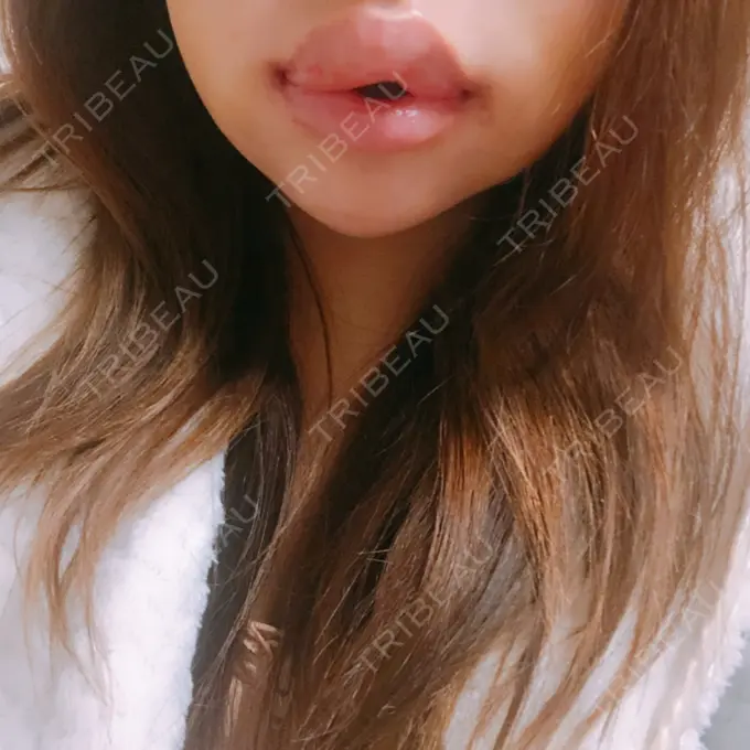 二重切開 / クマ治療 / 骨切り（あご） / 骨削り（エラ） / 骨削り（頬） / 脂肪吸引（顔） / 脂肪吸引（二の腕） / 下まぶたの脂肪取り / タレ目形成・グラマラスライン（切開） / 軟骨移植 / 骨切幅寄せ / ヒアルロン酸注入（涙袋） / その他（鼻） / その他（胸） ジュエリー美容外科 DAY 10 メイン用