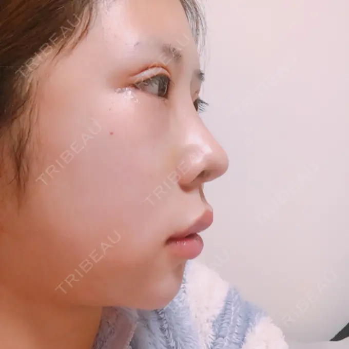 二重切開 / クマ治療 / 骨切り（あご） / 骨削り（エラ） / 骨削り（頬） / 脂肪吸引（顔） / 脂肪吸引（二の腕） / 下まぶたの脂肪取り / タレ目形成・グラマラスライン（切開） / 軟骨移植 / 骨切幅寄せ / ヒアルロン酸注入（涙袋） / その他（鼻） / その他（胸） ジュエリー美容外科 DAY 16 メイン用