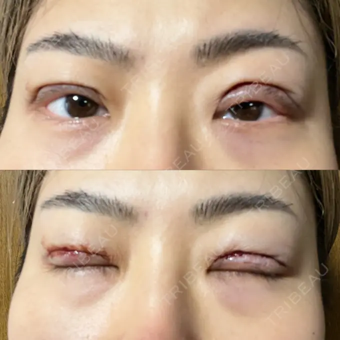 二重切開 みずほクリニック DAY 0 メイン用