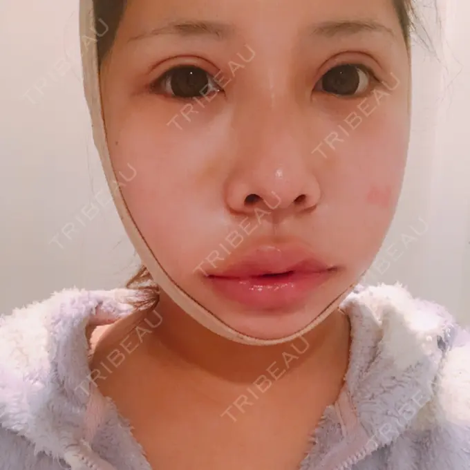 二重切開 / クマ治療 / 骨切り（あご） / 骨削り（エラ） / 骨削り（頬） / 脂肪吸引（顔） / 脂肪吸引（二の腕） / 下まぶたの脂肪取り / タレ目形成・グラマラスライン（切開） / 軟骨移植 / 骨切幅寄せ / ヒアルロン酸注入（涙袋） / その他（鼻） / その他（胸） ジュエリー美容外科 DAY 17 メイン用