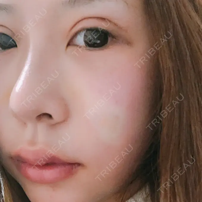 二重切開 / クマ治療 / 骨切り（あご） / 骨削り（エラ） / 骨削り（頬） / 脂肪吸引（顔） / 脂肪吸引（二の腕） / 下まぶたの脂肪取り / タレ目形成・グラマラスライン（切開） / 軟骨移植 / 骨切幅寄せ / ヒアルロン酸注入（涙袋） / その他（鼻） / その他（胸） ジュエリー美容外科 AFTER メイン用