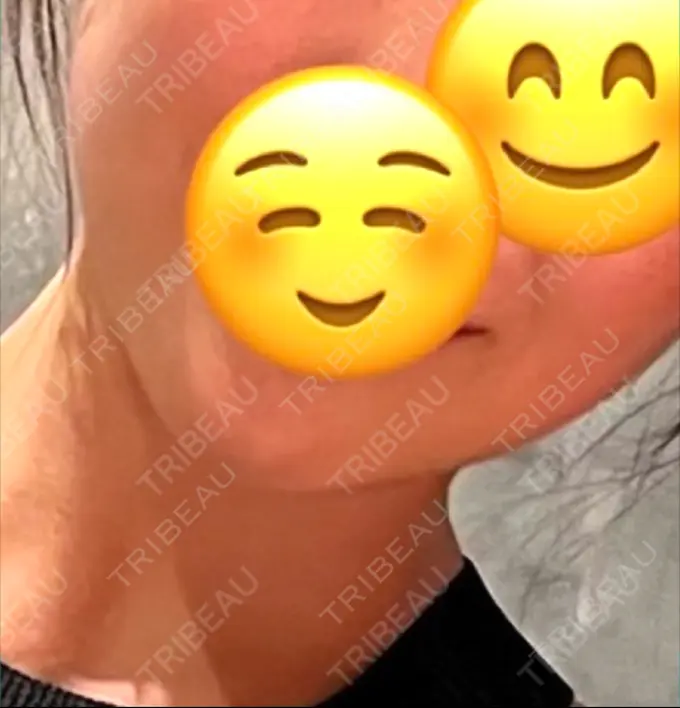 ボトックス（エラ・小顔） L‘amour clinic Tokyo【ラムールクリニック東京】 DAY 0 メイン用