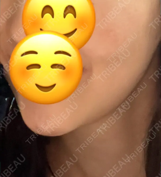 ボトックス（エラ・小顔） L‘amour clinic Tokyo【ラムールクリニック東京】 DAY 0 メイン用