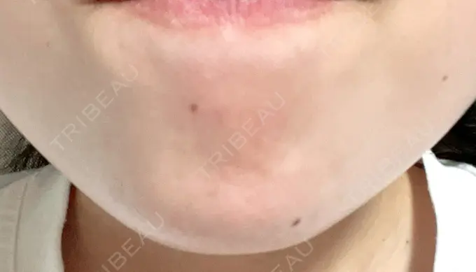 ボトックス（あご） フィラークリニック 町田院 AFTER メイン用