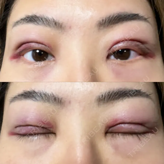 二重切開 みずほクリニック DAY 1 メイン用