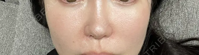 小鼻縮小（切開） / 鼻翼挙上 東京美容医療クリニック 池袋院 AFTER メイン用