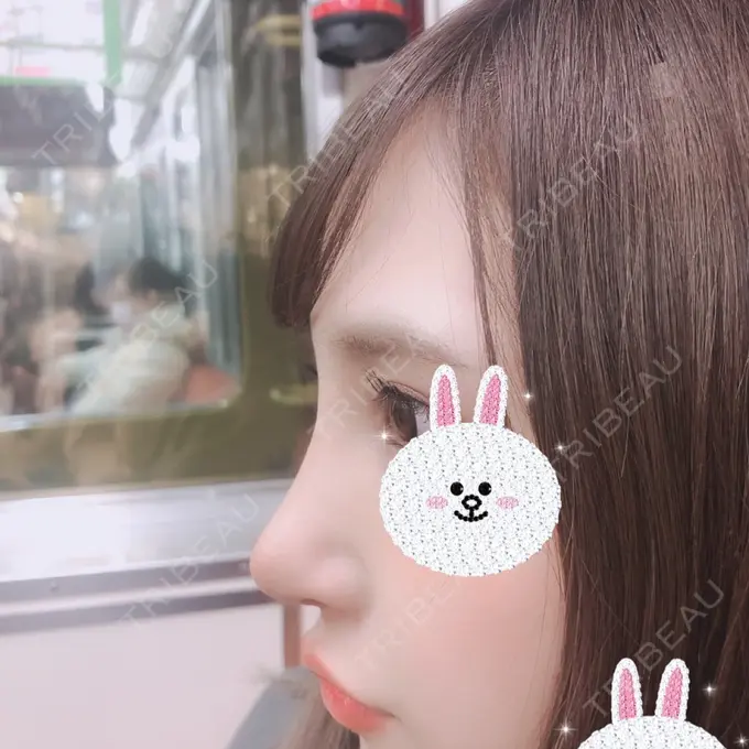 隆鼻術 / 鼻尖形成（切開） / 鼻中隔延長（切開） / 軟骨移植 / その他（鼻） FROM B整形外科 (旧バウム整形外科) DAY 8 メイン用