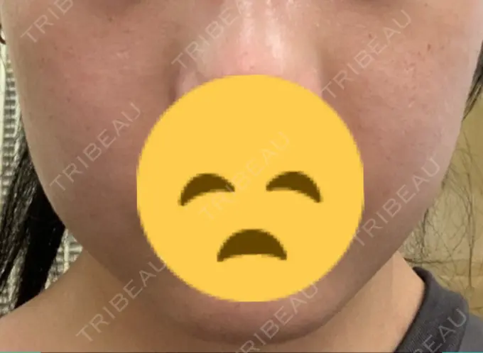 バッカルファット除去 Otus Clinic 【オータスクリニック】 DAY 3 メイン用