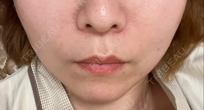 糸リフト 東京シンデレラ美容外科 新宿院 DAY 0 メイン用