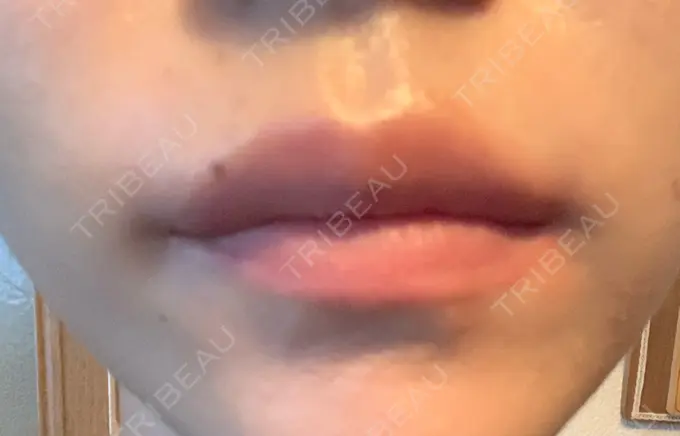 ボトックス（人中） veary clinic AFTER メイン用