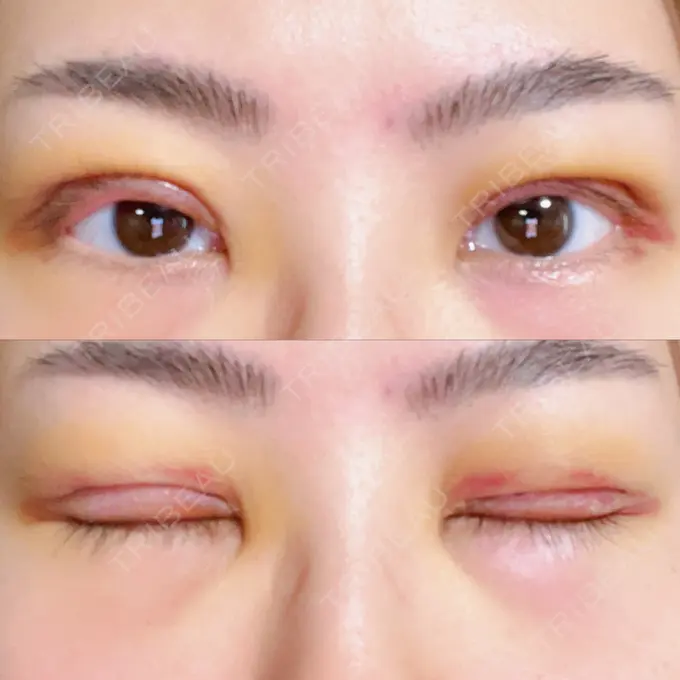 二重切開 みずほクリニック DAY 3 メイン用