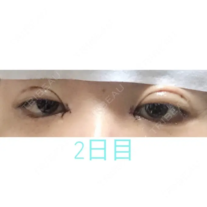 二重埋没 / 目頭切開 湘南美容クリニック 長野院 DAY 2 メイン用